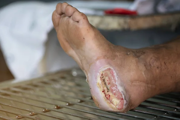 Úlcera de pie diabética infectada, enfoque selectivo — Foto de Stock