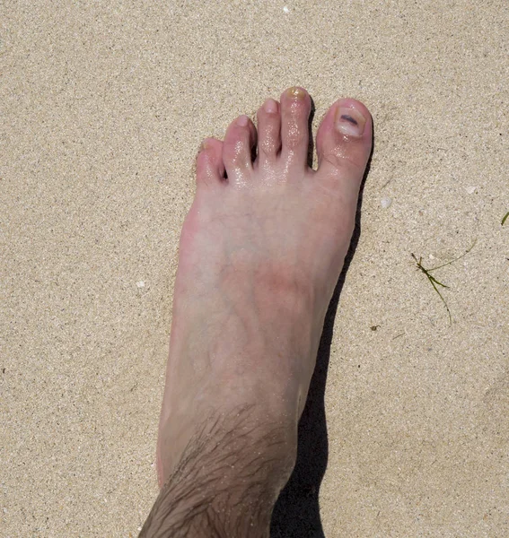 Schuppenflechte Fuß Einem Sehr Ernsten Zustand — Stockfoto