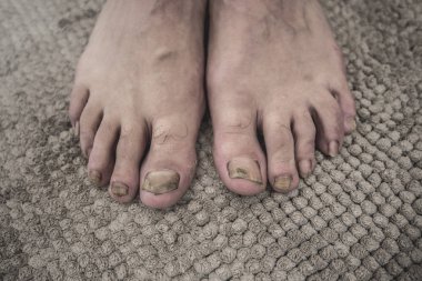 Kurtçuk deriyi ve tırnakları etkileyen mantarlardan kaynaklanan bir hastalıktır. Ayağım çok hasta..