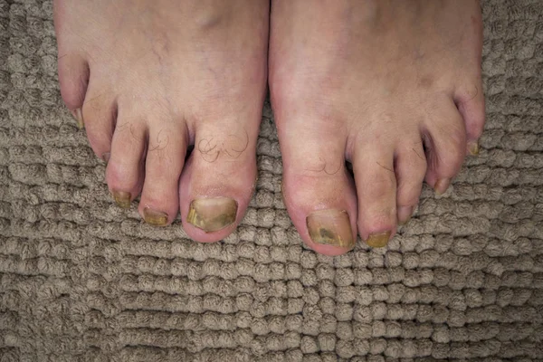 Ringworm is a disease caused by fungi that can affect the skin, nails. Foot very sick.