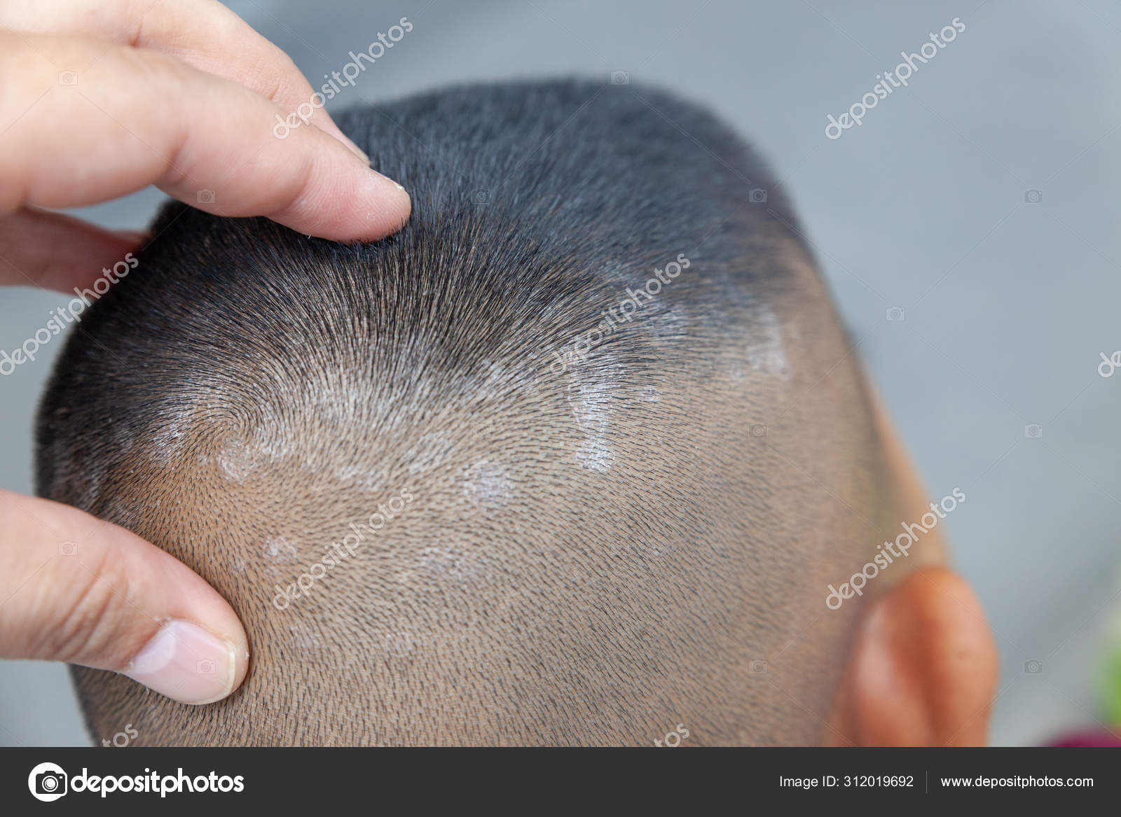 Closeup skin head , scalp, photos of dermatitis and eczema, ski Stock