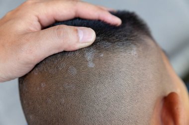 Close-up skin head , scalp, photos of dermatitis and eczema, ski clipart