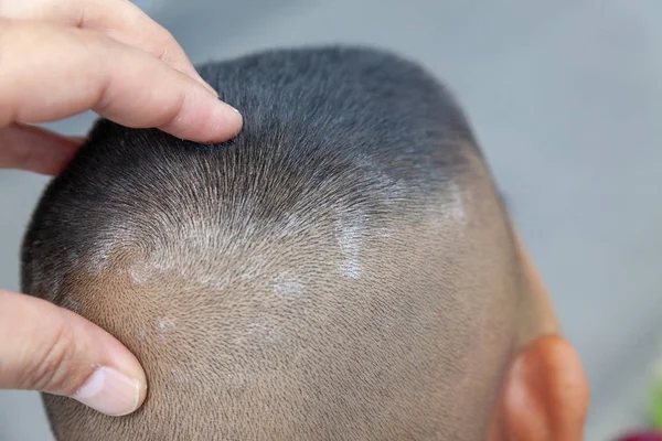 Cabeza de piel de cerca, cuero cabelludo, fotos de dermatitis y eczema, esquí — Foto de Stock