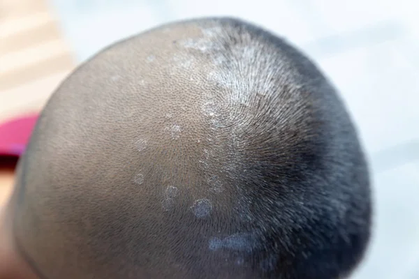 Close-up skin head , scalp, photos of dermatitis and eczema, ski — Stock Photo, Image