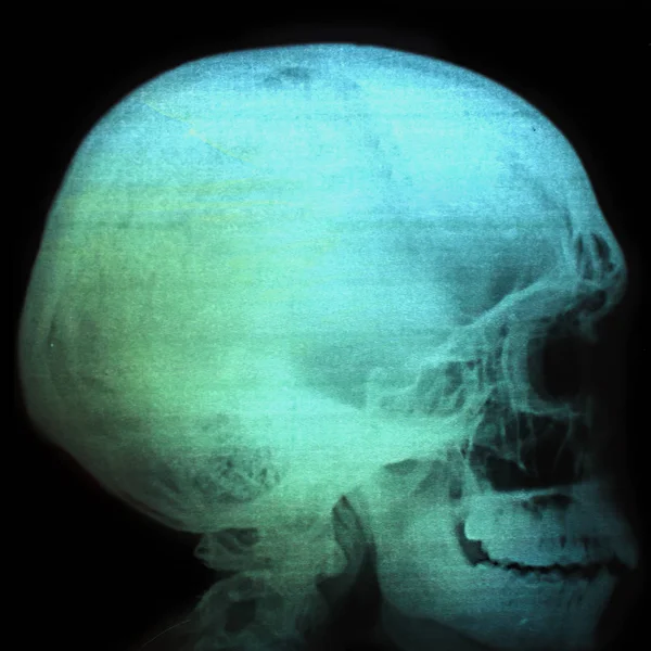 Tomografiska Tycks Undersökning Röntgenbild Ett Mänskligt Huvud — Stockfoto