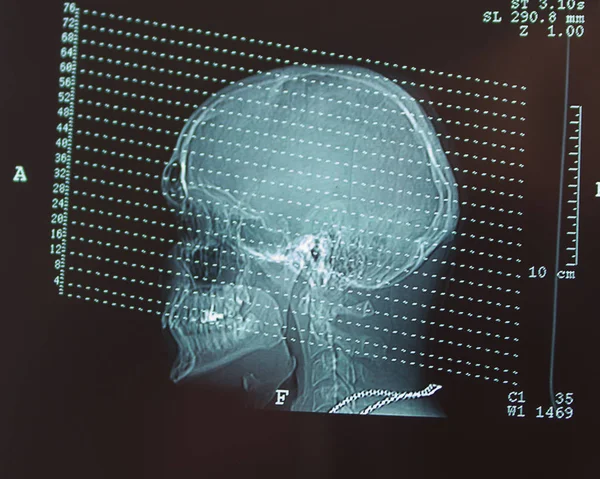 Томографічний Огляд Рентгенівського Зображення Голови Людини — стокове фото