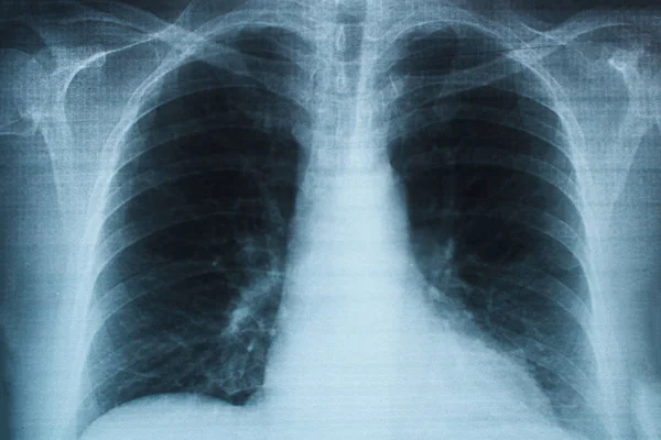 Nsan Göğsünün Röntgen Görüntüsü Akciğer Sağlığı Sorunları — Stok fotoğraf