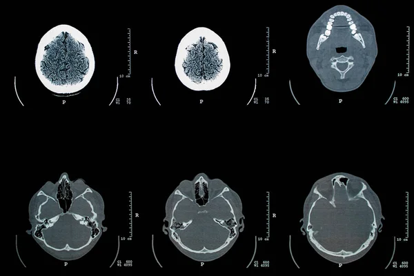 Examen Tomográfico Radiografía Una Cabeza Humana — Foto de Stock