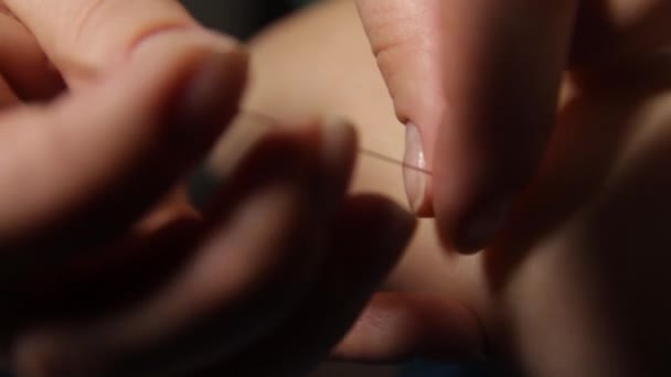 Acupuncture.Aiguille sec. Gros plan d'une aiguille collée dans l'avant-bras d'un patient.Thérapie par points de déclenchement.Médecine traditionnelle chinoise 