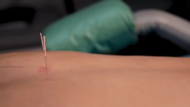 Trigger Point therapie. Droge Needling. Reflexologie specialist zet naalden op een Womans terug. Traditionele Chinese geneeskunde. Acupunctuur — Stockvideo