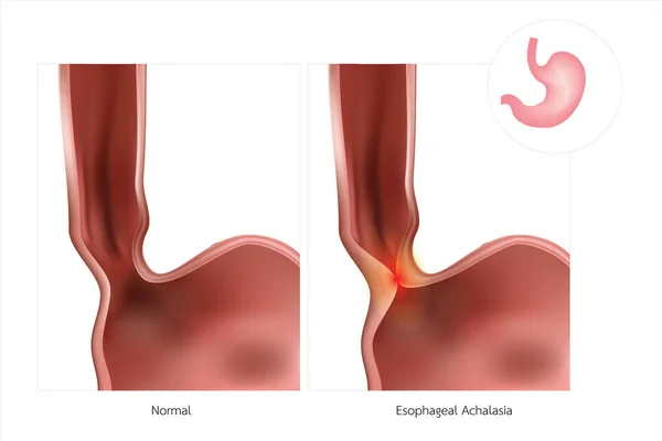 The stomach or esophagus is often referred to as simple Achalasi — Stock Photo, Image