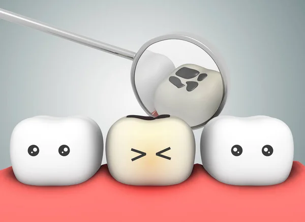 Ząb Koncepcyjny Próchnicy — Zdjęcie stockowe