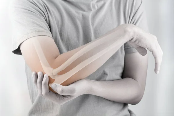 肘の骨の怪我白い背景肘の痛み — ストック写真