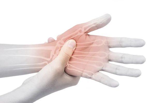 Verletzung Der Handgelenkknochen Weißer Hintergrund Schmerzen Handgelenk — Stockfoto