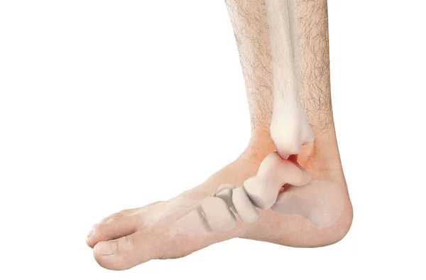 Foot Bones Pain White Background Foot Injury — Stock Photo, Image