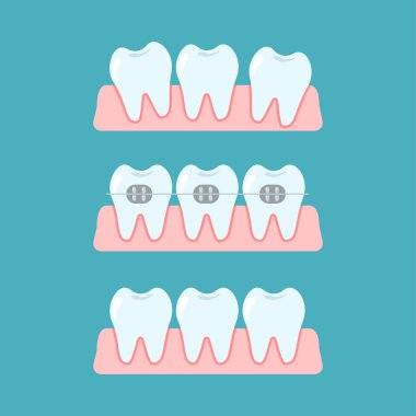 Diş tellerinde ortodonti tedavisi aşamaları. Isırık izleri, diş telleri, diş telleri, dişbilimi konsepti. Vektör düz çizgi film illüstrasyonu