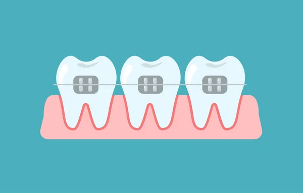 Alineación Mordedura Los Dientes Fila Dental Con Aparatos Ortopédicos Ortodoncia — Archivo Imágenes Vectoriales