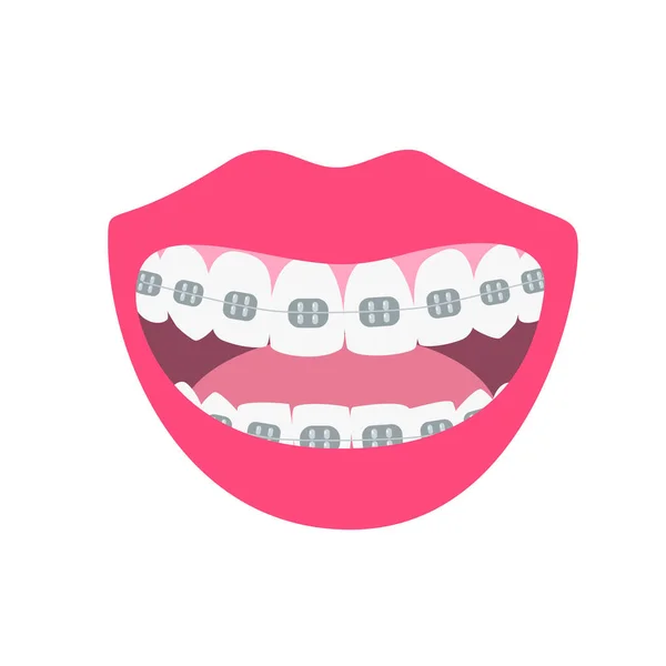 Glada Leenden Visar Uppriktning Och Vitare Tänder Process Anpassning Bita — Stock vektor