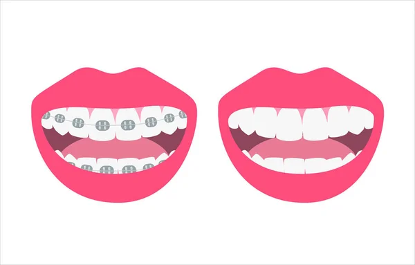 Glückliches Lächeln Das Sich Vor Und Nach Der Zahnausrichtung Und — Stockvektor