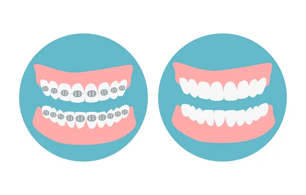Vor Und Nach Dem Ausrichtungsprozess Der Zähne Zahnausrichtung Zahnreihe Mit — Stockvektor