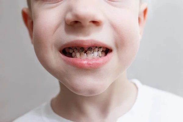 Крупный план зубов мальчика с кариесом. Здравоохранение, зубная истерика и детская концепция. Проблемы с зубами — стоковое фото