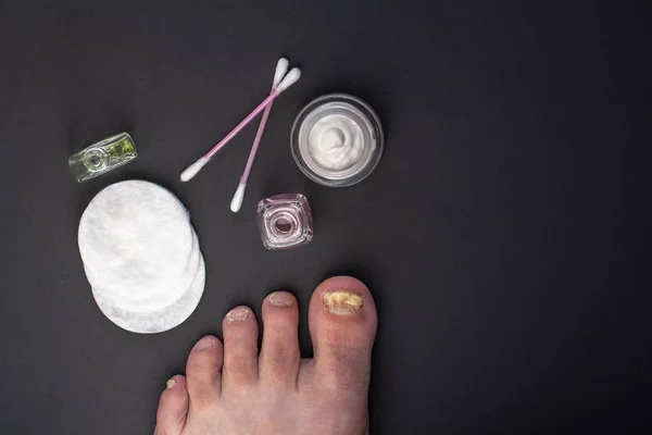 Flat lay. Fungus on the toenail. Tools for the care of affected nails. Cream in a jar, cotton pads and cotton buds, bottles of liquid. Dark background.