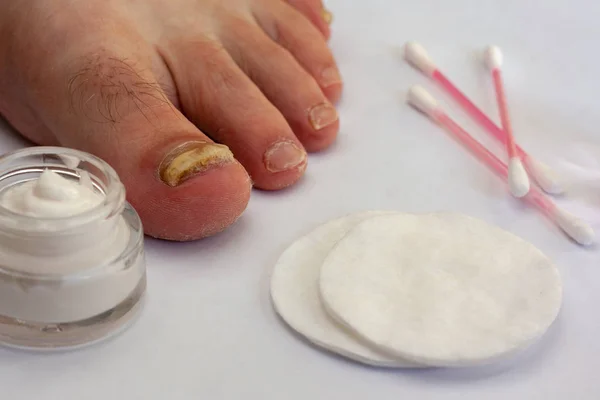 Toenail Affected Fungus Cream Jar Cotton Pads Cotton Buds Selective — Stock Photo, Image