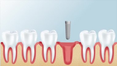 Diş implantı kurulum süreci, medikal olarak doğru üç boyutlu illüstrasyon beyaz stili. 4k hareket videosu.