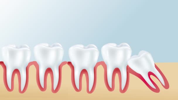 知恵歯肉を持つ歯茎が混雑を引き起こします 影響を受ける知恵の歯による問題が含まれる — ストック動画