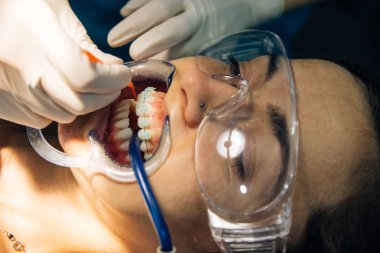 bir diş hekimi kız ile bir diş kliniğinde beyaz bir kız beyaz diş parantez yerleştirme süreci