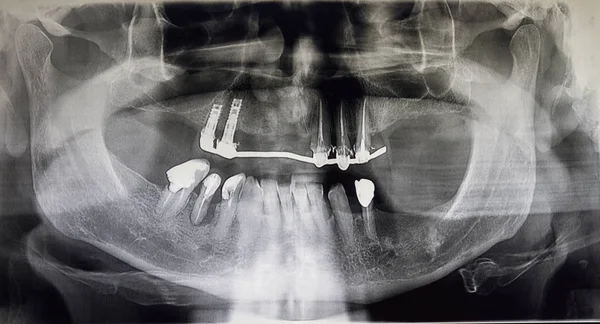 Ortoantomografia de um doente adulto — Fotografia de Stock