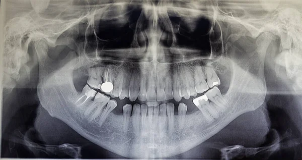 Ortopantomografía de un paciente adulto —  Fotos de Stock