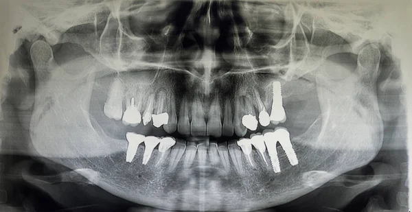 Ortoantomografia de um doente adulto — Fotografia de Stock