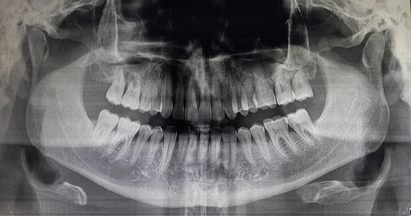 Ortoantomografia de um doente adulto — Fotografia de Stock