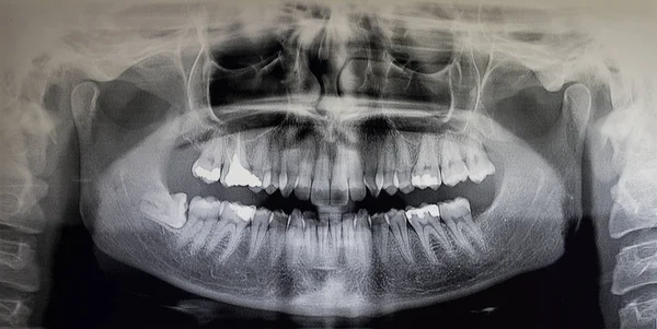 Ортопантомография взрослого пациента — стоковое фото