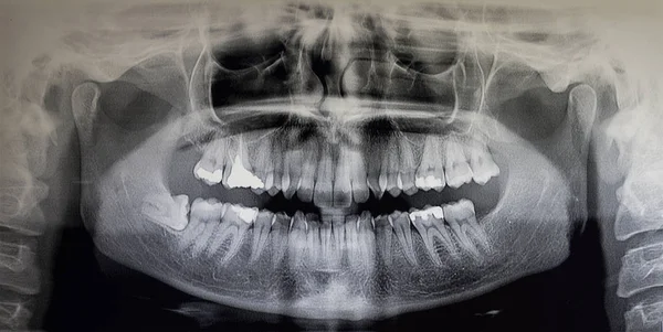 Orthopantomography of an adult patient — Stock Photo, Image