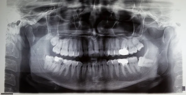 Ortoantomografia de um paciente adulto, odontologia — Fotografia de Stock