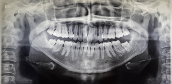 Yetişkin bir hastanın ortomografisi, dişçilik