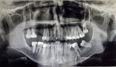 Yetişkin bir hastanın ortomografisi, dişçilik