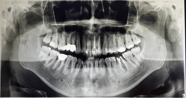 Ortoantomografia de um paciente adulto, odontologia — Fotografia de Stock