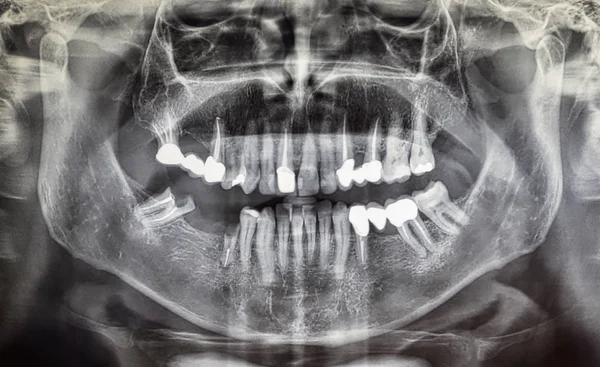 Ortoantomografia de um paciente adulto, odontologia — Fotografia de Stock