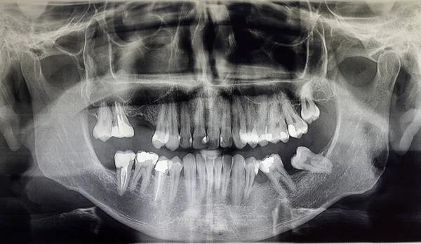 Ortoantomografia de um paciente adulto, odontologia — Fotografia de Stock