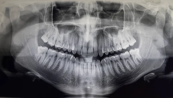 Ортопантомографія дорослого пацієнта, стоматологія — стокове фото