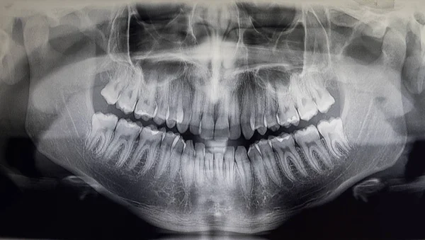 Ortoantomografia de um paciente adulto, odontologia — Fotografia de Stock