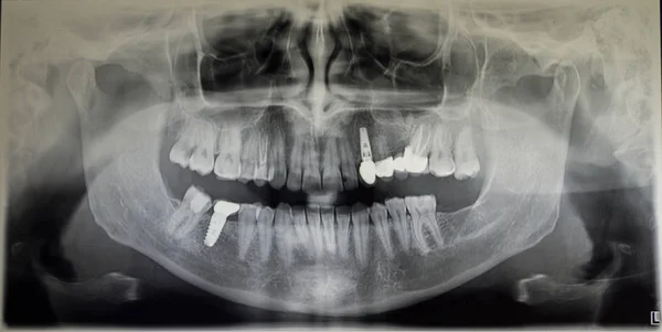 Ortoantomografia de um paciente adulto, odontologia — Fotografia de Stock