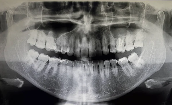 Ortoantomografia de um paciente adulto, odontologia — Fotografia de Stock