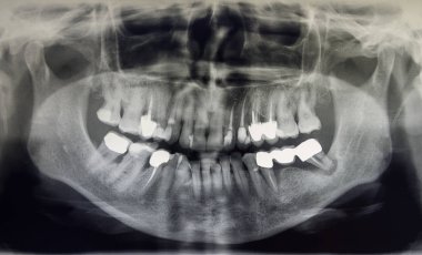 Yetişkin bir hastanın ortomografisi, dişçilik