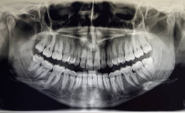 Yetişkin bir hastanın ortomografisi, dişçilik