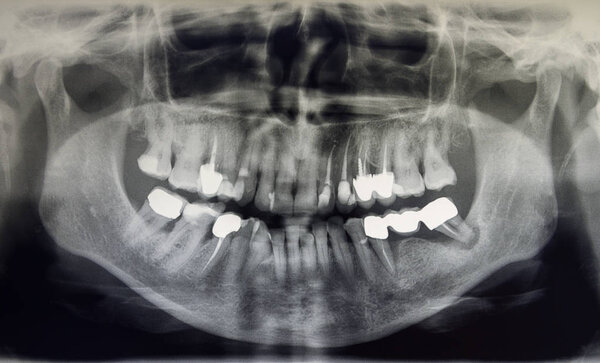 Orthopantomography of an adult patient, dentistry