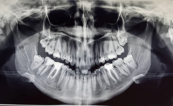 Ortopantomografi av en vuxen patient, tandvård — Stockfoto